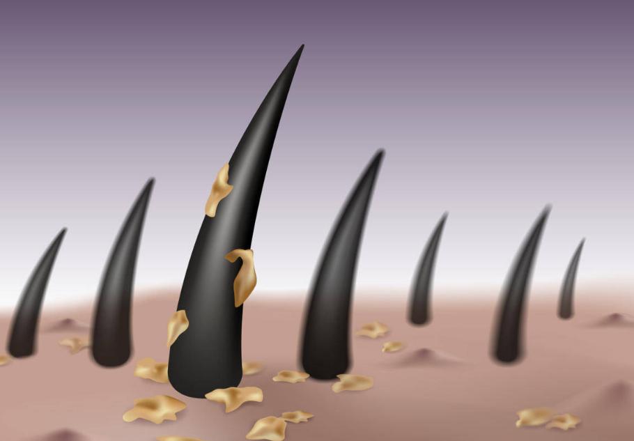 头皮总是长疙瘩或脓包是什么原因,头皮反复长疖肿起脓包