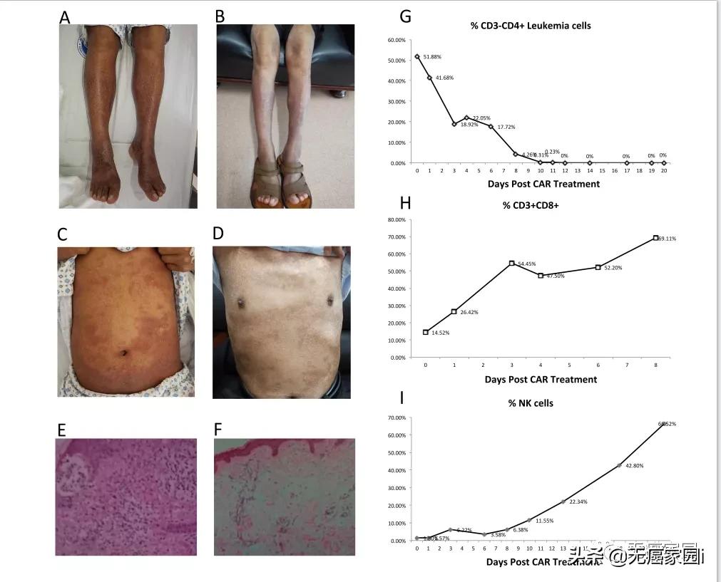cart治疗淋巴瘤复发率,car-t细胞疗法能治愈淋巴瘤吗