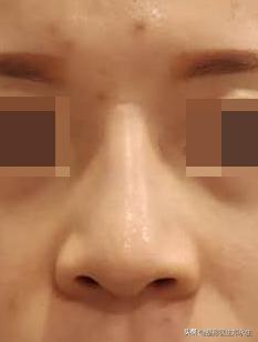 被老公打歪鼻骨留下后遗症,女的鼻子被打歪了