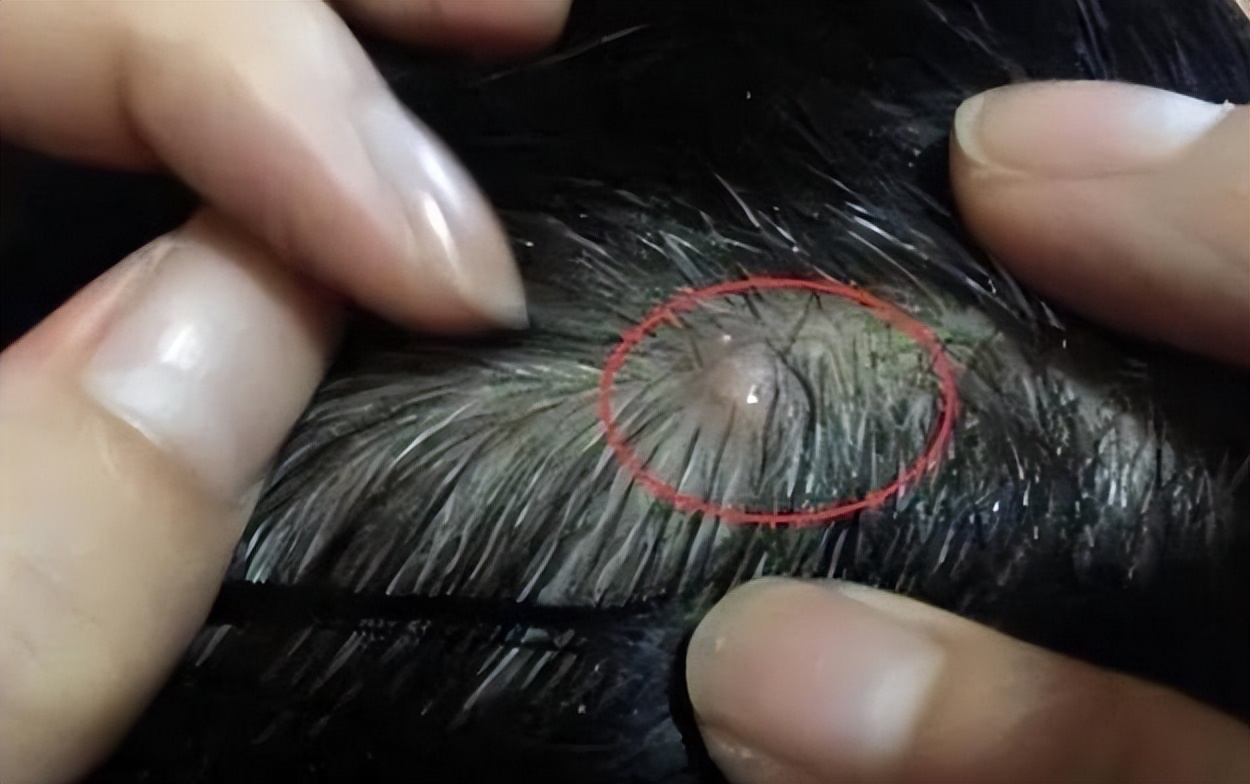 头皮上老是长脓包怎么回事,头皮上总是长疙瘩和脓包如何根治