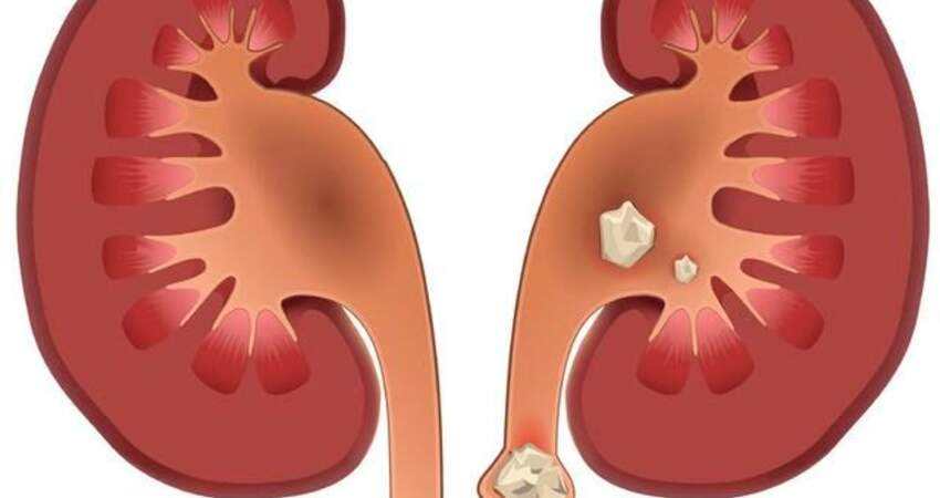硬水喝多了易得结石。家里自来水是硬水该怎么办？