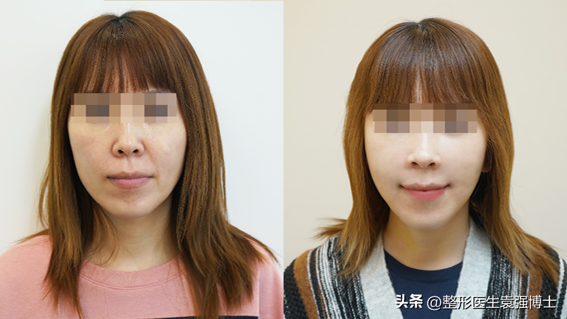 法令纹难解决,法令纹好严重怎么办