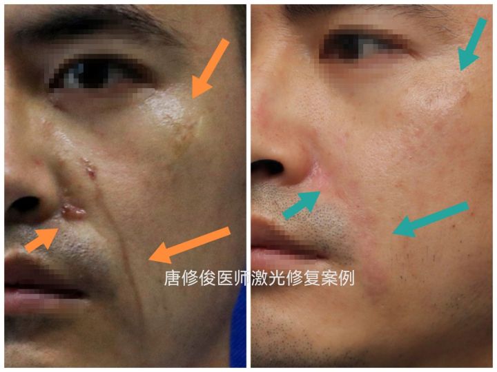 点阵激光后的伤口要几天愈合,点阵激光对去除疤痕效果明显吗