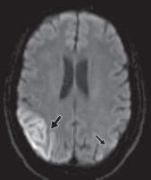脑水肿的影像,脑水肿形成机制生理学