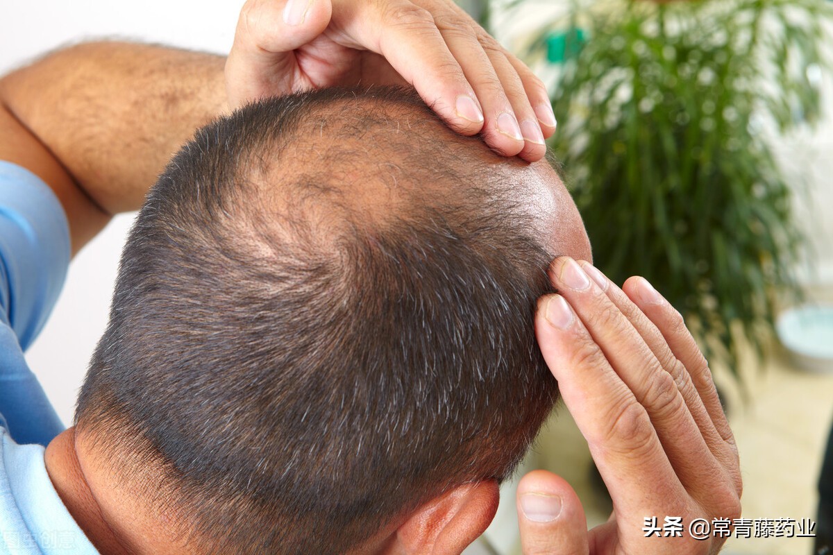 脱发治疗需要花费多少钱,脱发怎么治疗最省钱