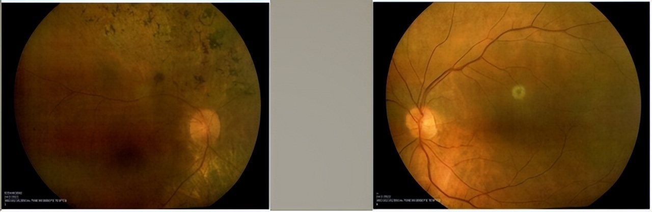 视网膜炎oct的详细图解,视网膜色素变性oct检查