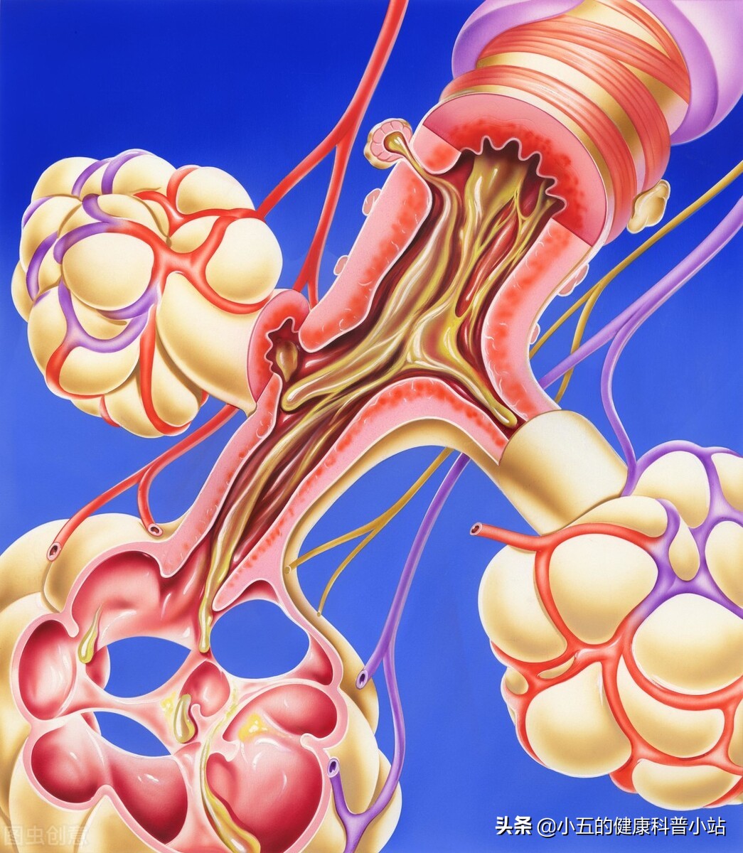 乙酰半胱氨酸治疗慢性支气管炎吗,乙酰半胱氨酸片直接口服