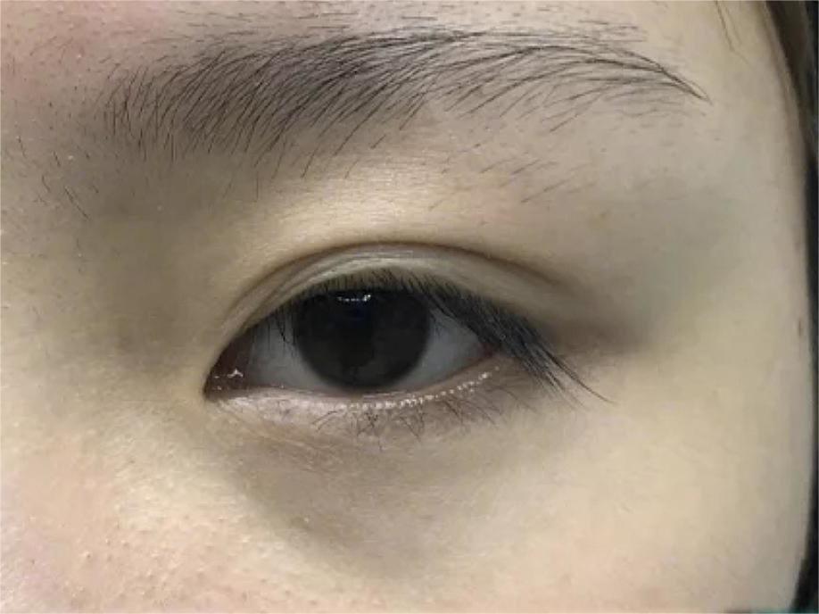 双眼皮手术后眼睛淤紫怎么消除,双眼皮术后眼头紧绷有细纹
