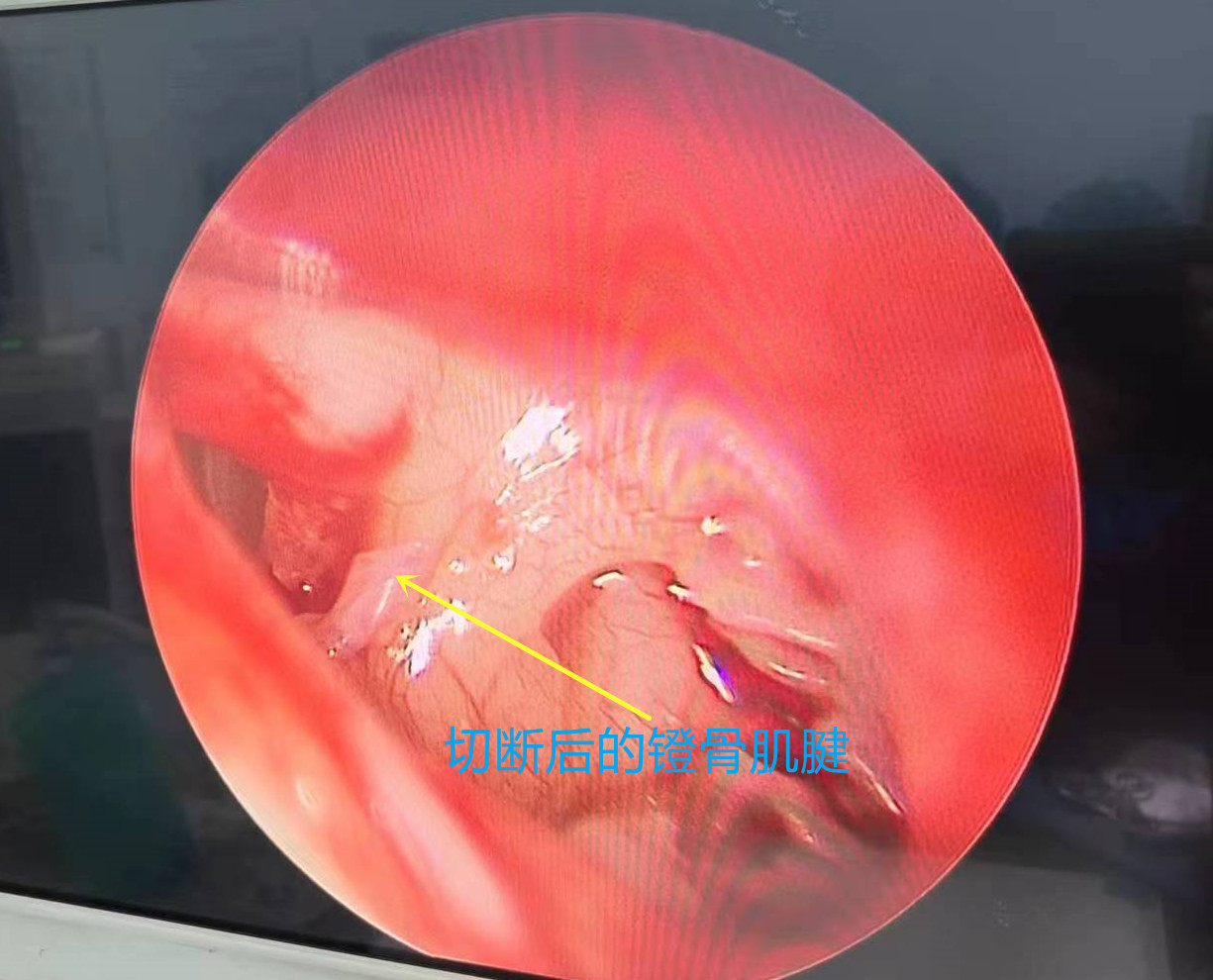 面肌痉挛耳后微创治疗,面肌痉挛外科微创诊治副作用