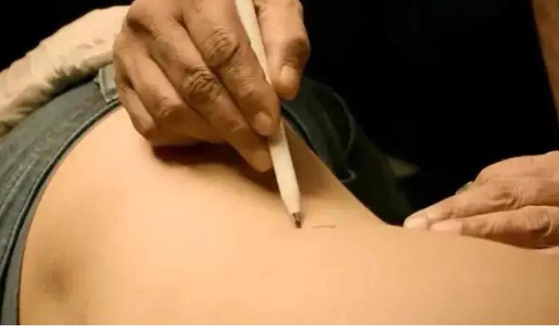 尼泊尔“卖肾村”：穷人们以700美元高价出售，人人身上一道疤