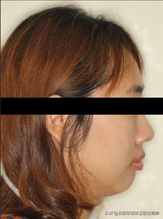 嘴凸的人怎么笑起来好看,嘴凸怎么让自己不焦虑