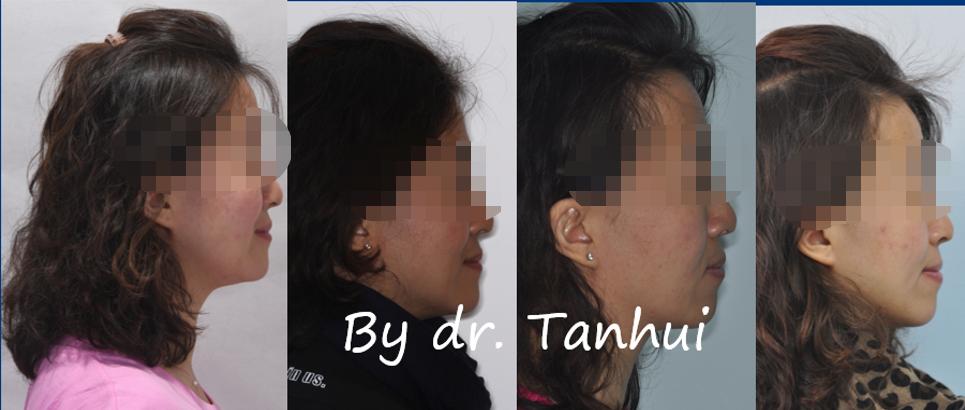 地包天能做手术矫正吗,儿童地包天矫正几岁做最好