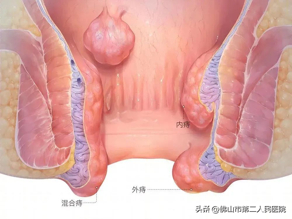 春节放肆嗨，节后便秘肛裂出血，难道是……