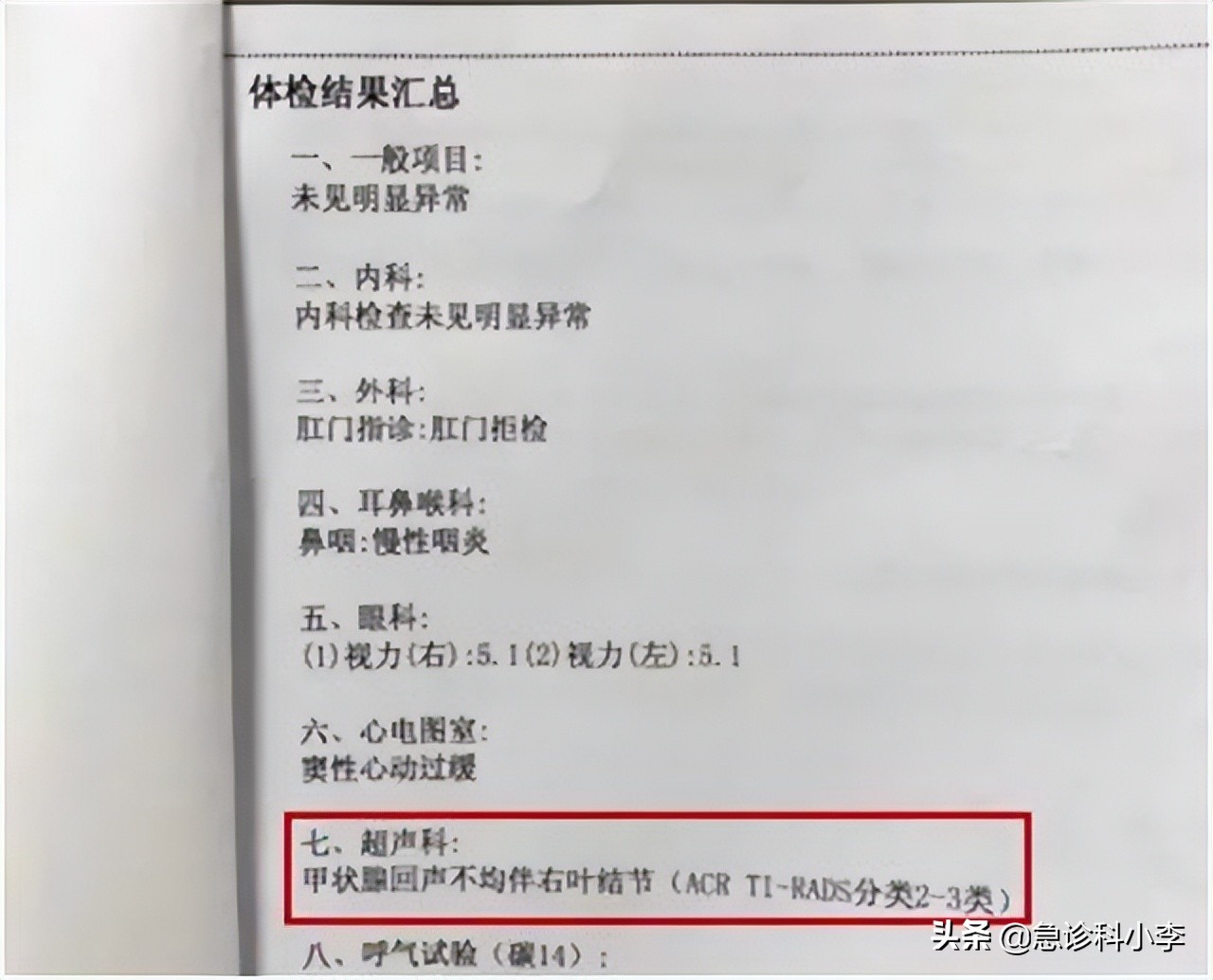 甲状腺结节伴有甲亢最好治疗方法,检查出甲状腺结节怎么办
