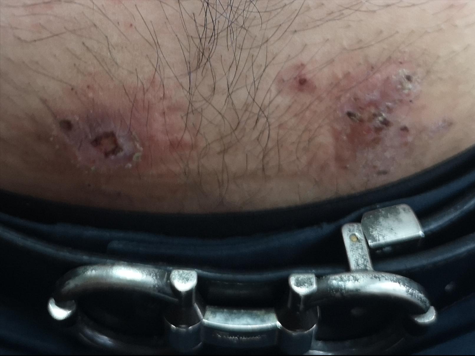 对镍过敏是怎么回事,镍过敏的人多不多