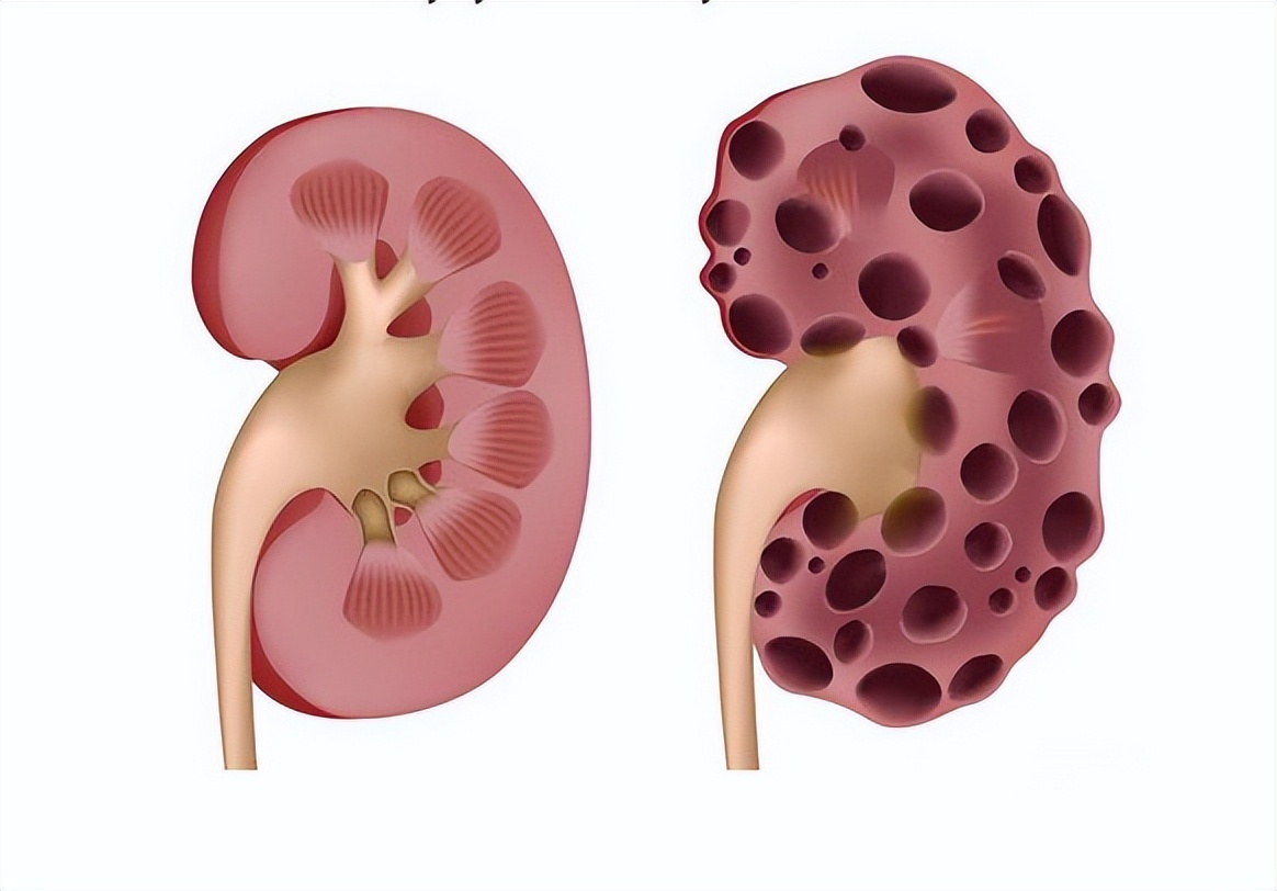 得了肾囊肿该怎么办,查出肾囊肿