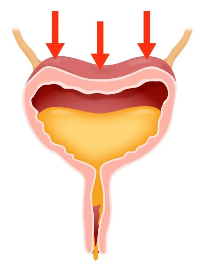 拉拉裤漏尿怎么回事,一跳就漏尿怎么回事