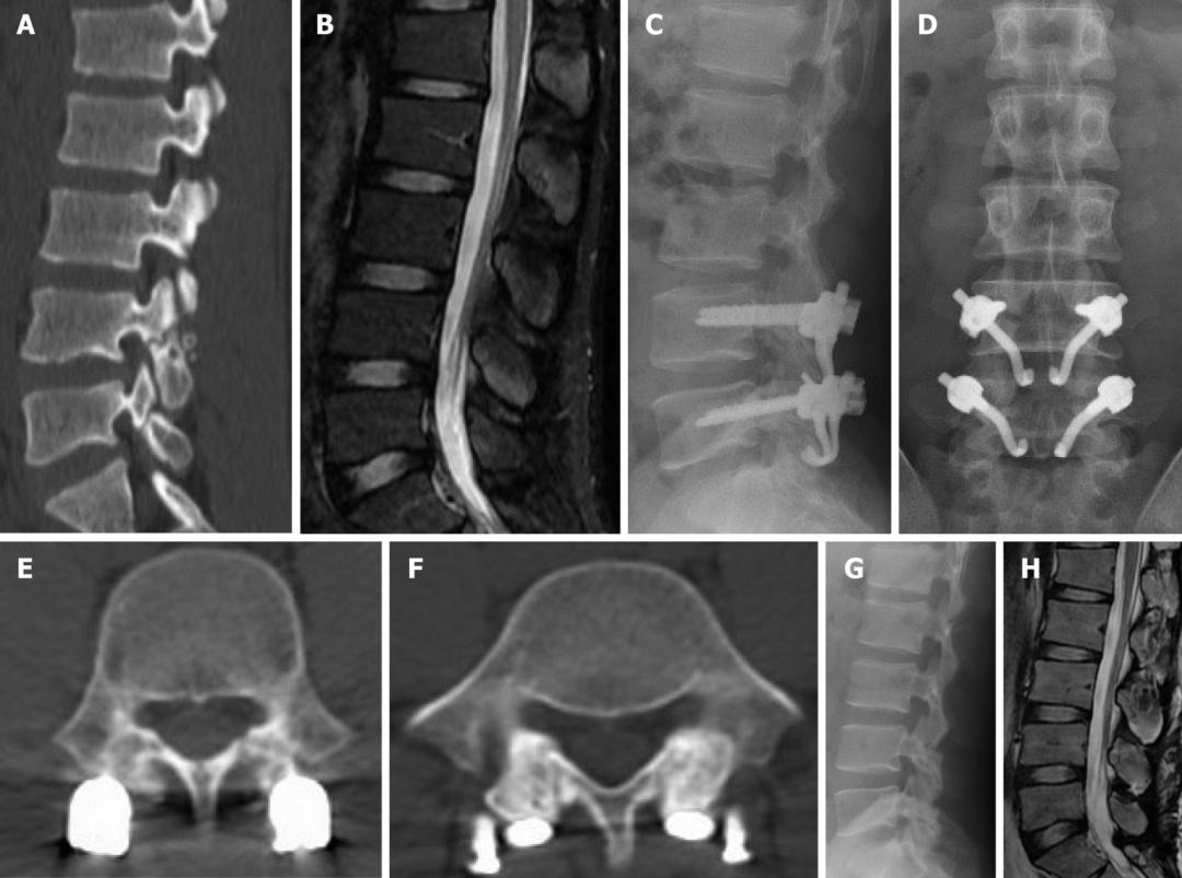 轻度峡部裂和重度峡部裂的区别,真性峡部裂和假性峡部裂