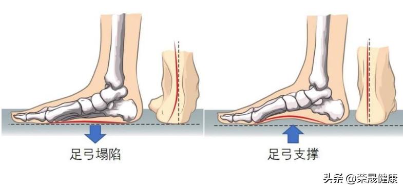 不想成为“唐老鸭”，这些在家就能做的平足练习一定要学起来！