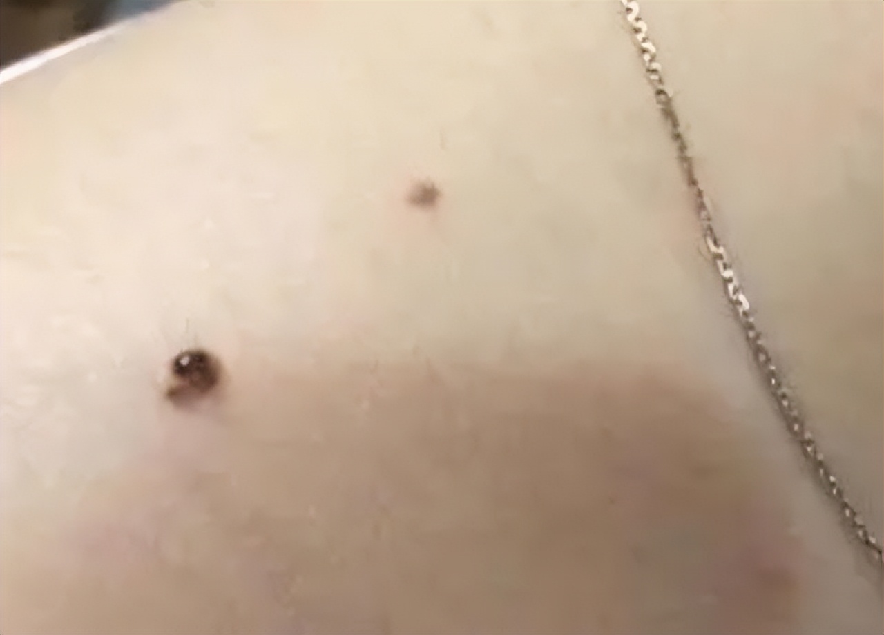 小孩痣长在什么地方代表什么,孩子身上的痣真的能预示未来