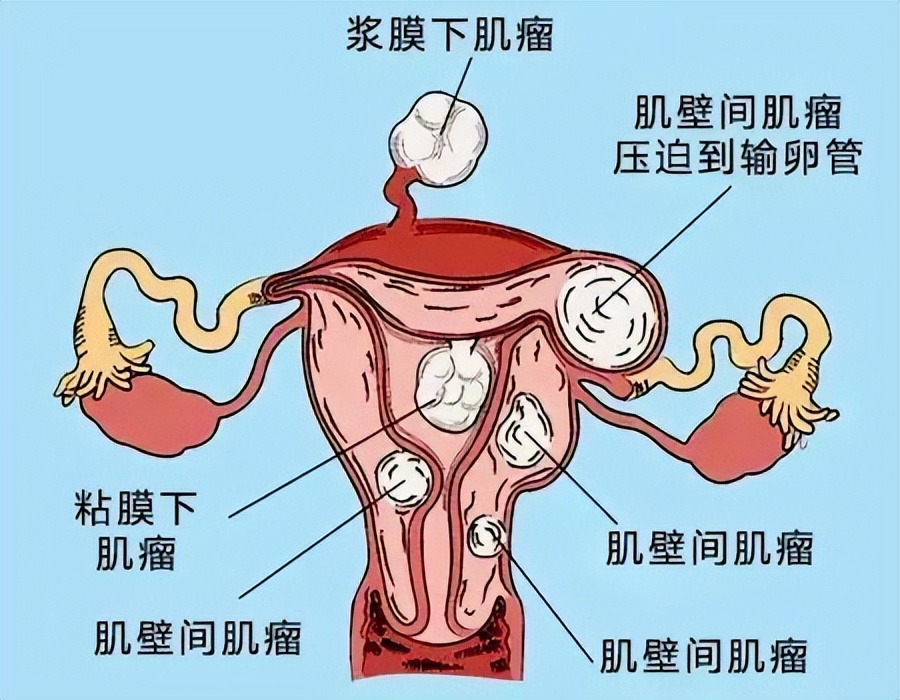 科普健康｜腹腔镜下子宫肌瘤剥除术