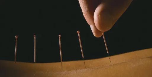 祛湿气针灸穴位,针灸的功效与作用可以祛湿气吗