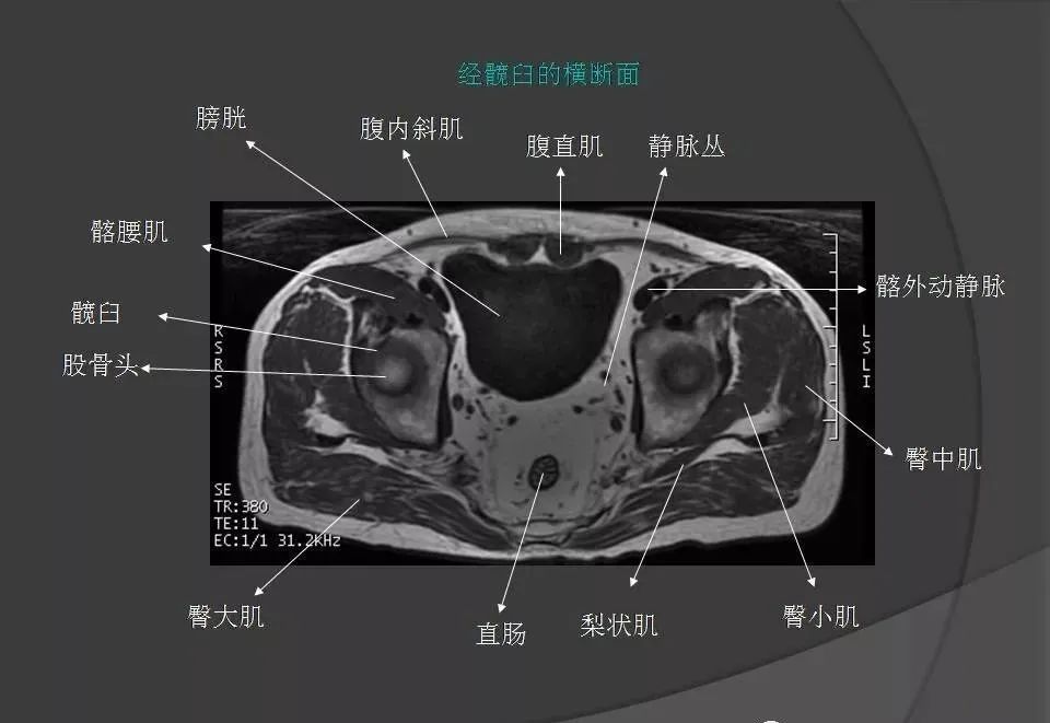 女性盆腔ct连续断层解剖图,盆腔mri影像病例分析