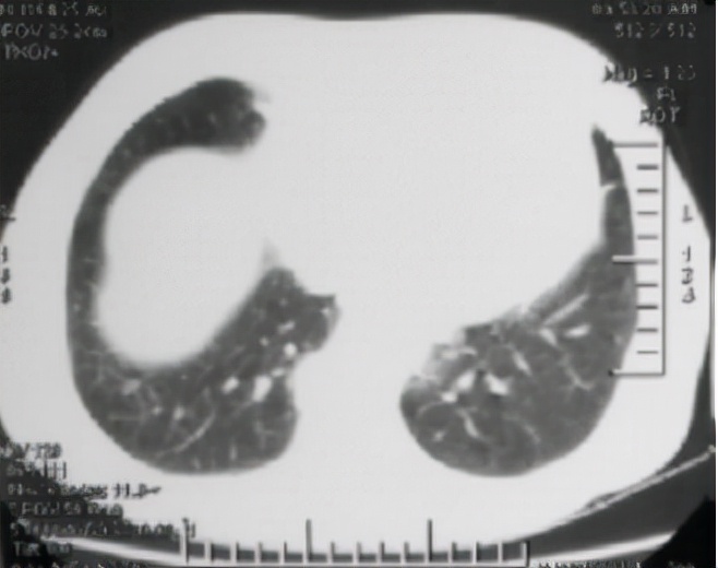 经常咳嗽检查是肺结节是怎么回事,长期咳嗽被误诊为哮喘