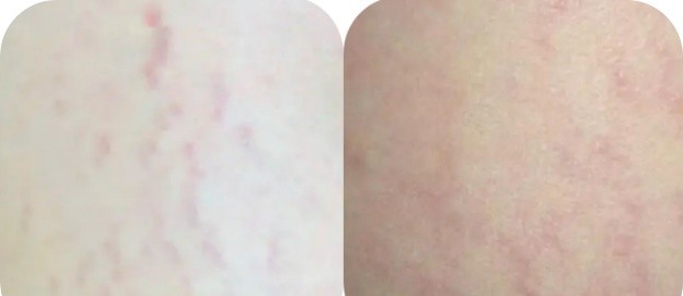 孕期如何防止妊娠纹孕妈你知道吗,孕期防妊娠纹最省钱的方法