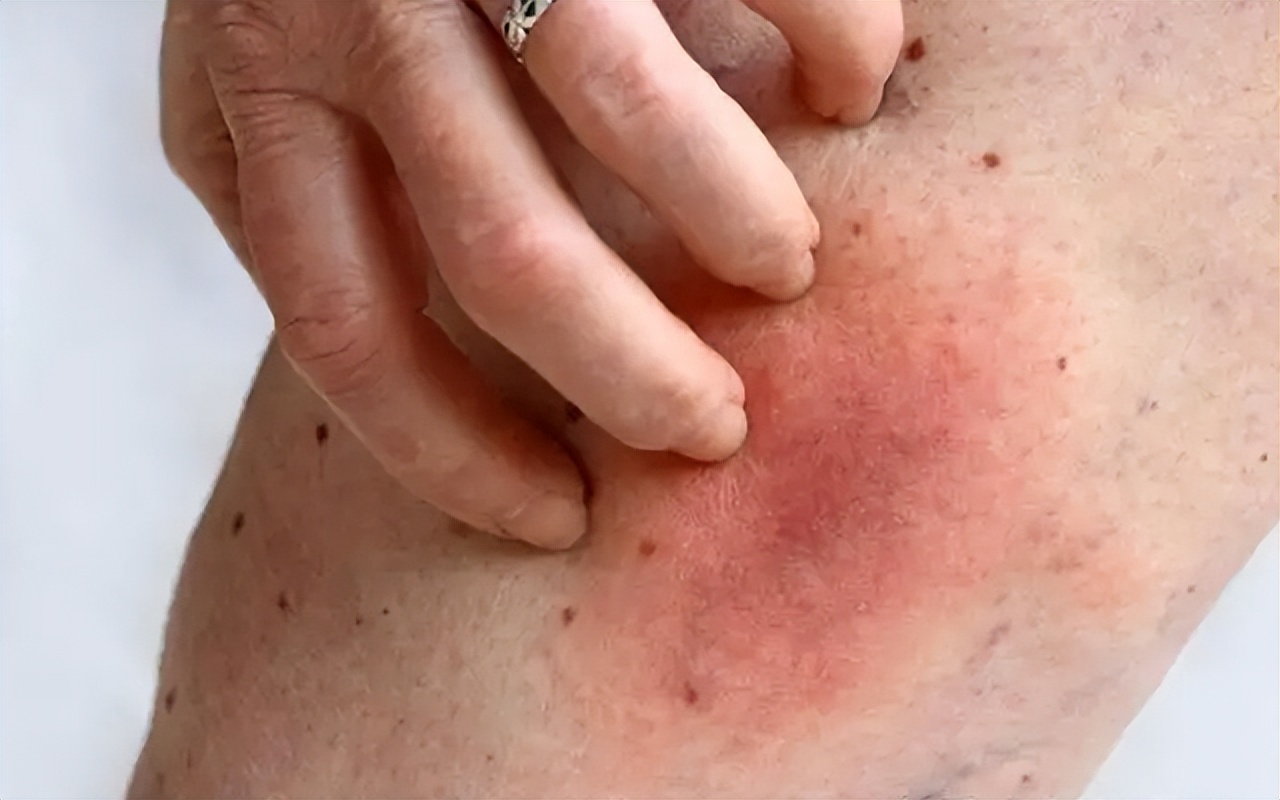 过敏性紫癜会越来越严重吗,过敏性紫癜伴随腿疼严重吗