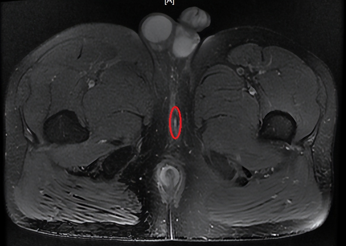 同样是肛瘘,为什么别人术后2天就出院,而我术后七天还出不了院