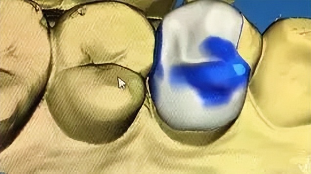 补牙跟嵌体有什么区别哪个更牢固,补牙为什么非要根管