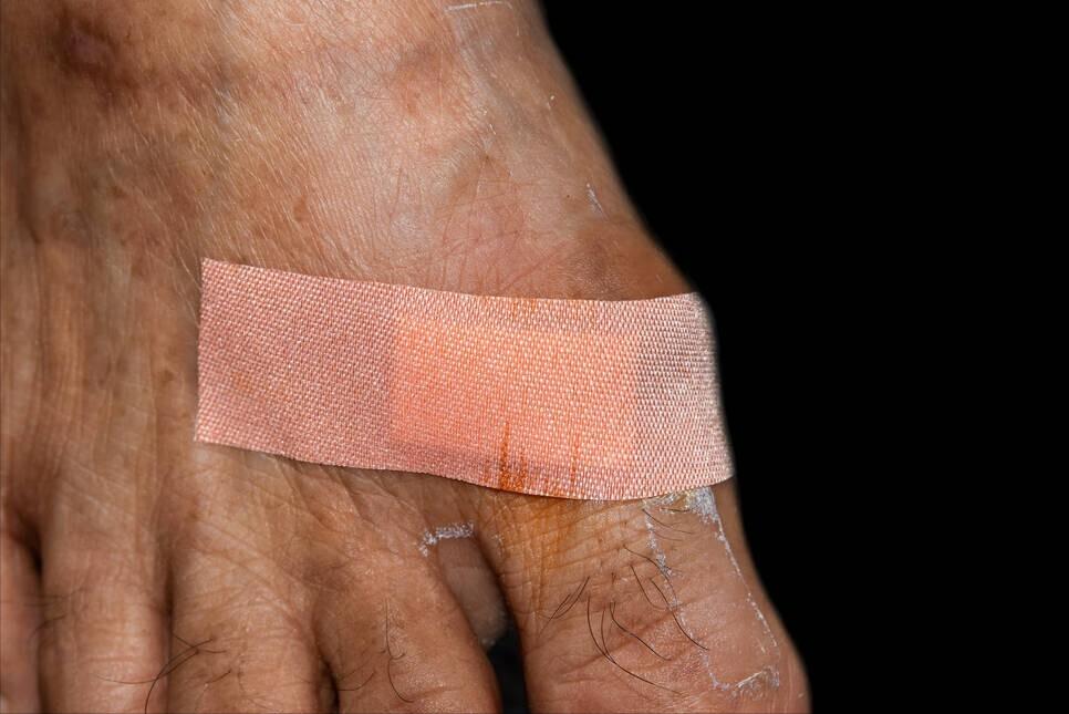 肺癌开放性手术伤口多久能够愈合,肺癌手术后里面伤口多久可以好