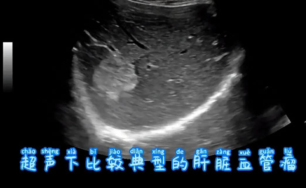 肝内血管瘤和肝癌超声怎么区分,肝占位病理检测项目