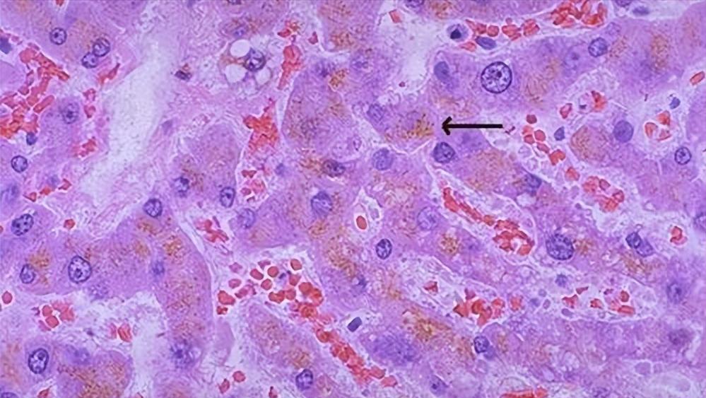 牙膏老年斑的克星,牙膏原来是治老年斑的特效药