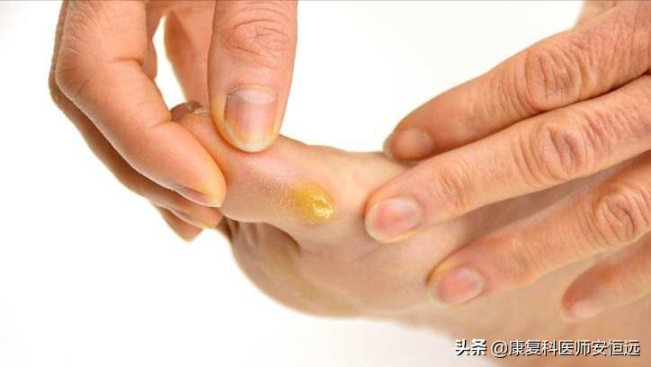 脚底板爱发烫是什么原因,脚底板生茧很疼怎么回事
