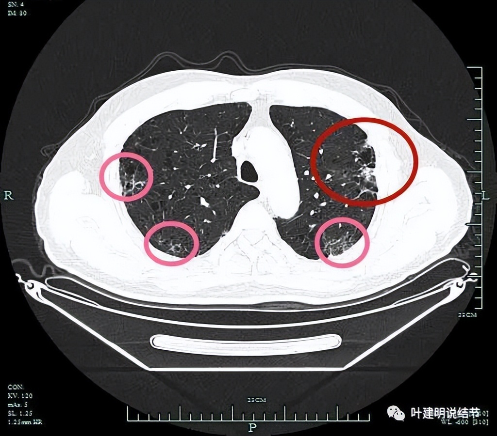 pet判断淋巴结转移,petct判断癌有没有转移准确吗