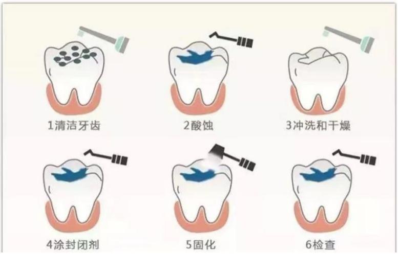 国家免费窝沟封闭预防龋齿项目,预防儿童牙齿龋齿最有效的办法