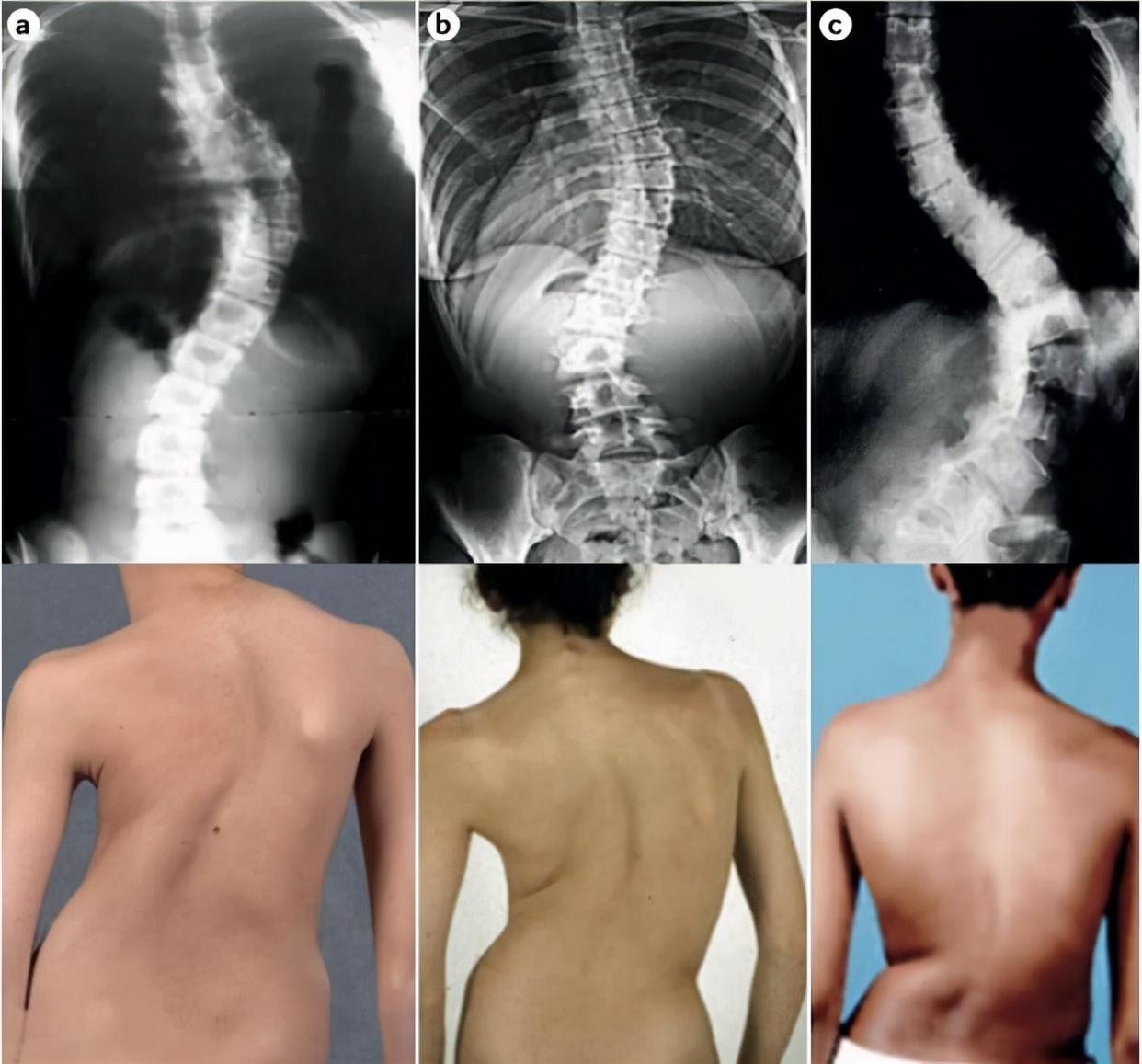半椎体畸形是一种先天性疾病,患者的症状多有脊柱侧凸的状况出现