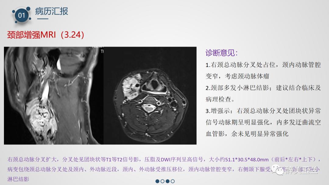 颈动脉体瘤切除术患者的麻醉管理,PPT课件