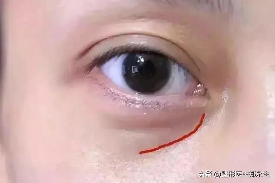 眼袋手术失败再次修复完交费吗,修复失败眼袋手术效果好吗