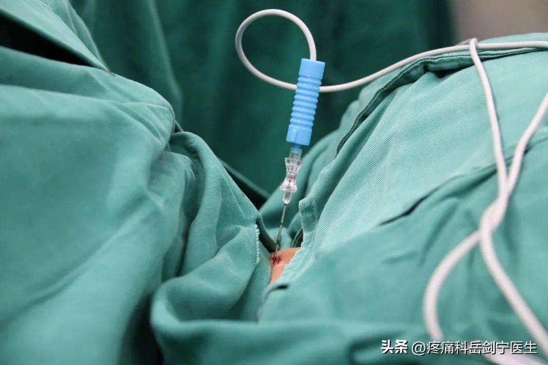 椎间盘突出微创介入疗法图片,椎间盘射频靶点消融术图解