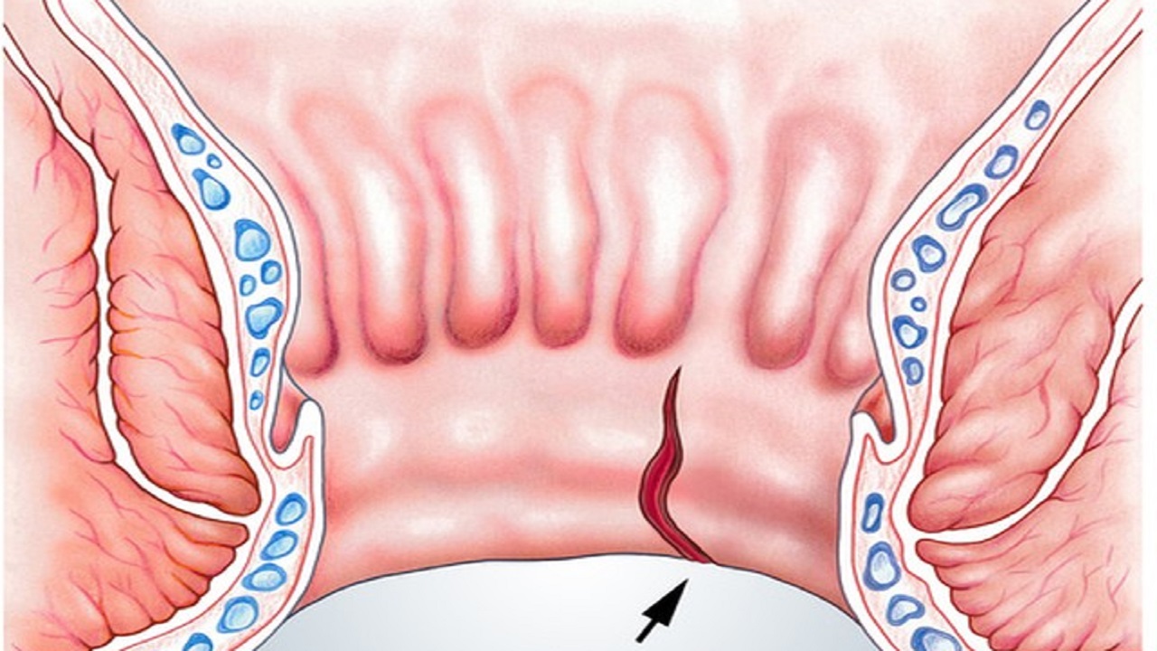 26岁女孩多次肛裂,女性哪些生活习惯会引发肛裂