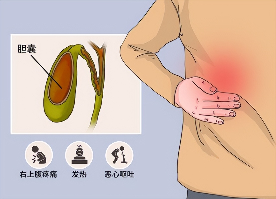 急性胆囊炎发作的原因有哪些,急性胆囊炎的症状及治疗都有哪些