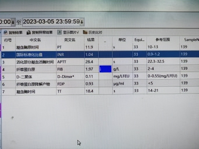 下肢肌间静脉畸形治疗案例,臀部静脉畸形怎么治疗比较好