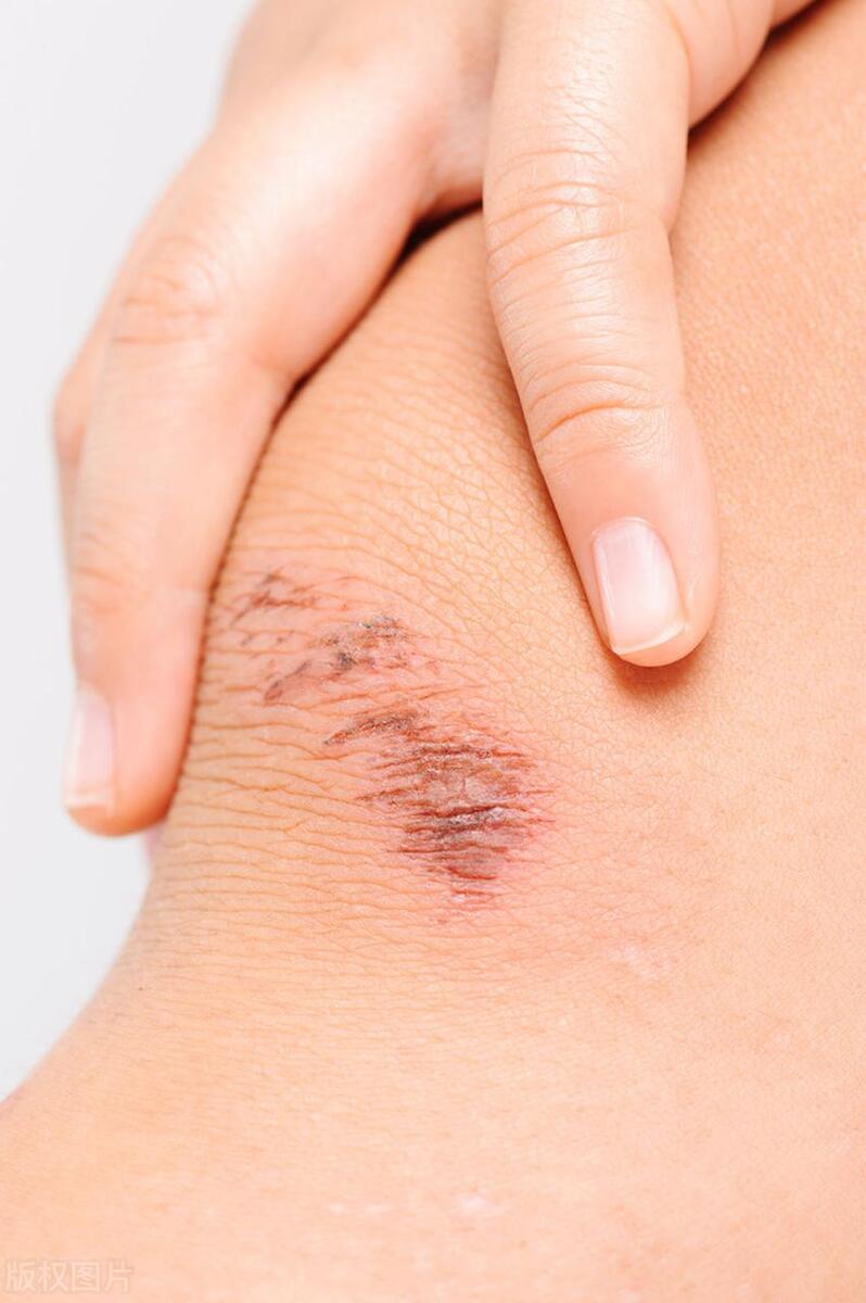 四种常用的皮肤消毒剂,处理伤口消毒最好用的消毒剂