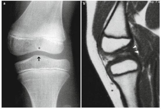 胫骨内翻与先天性前交叉韧带缺失磁共振诊断