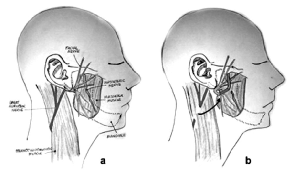 腮腺癌手术后面瘫是否可治愈,面瘫就一定是恶性腮腺瘤吗