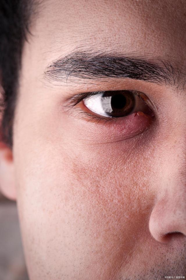 一觉睡醒眼睛肿了看不清东西,睡醒眼睛肿了怎么办消肿最快方法