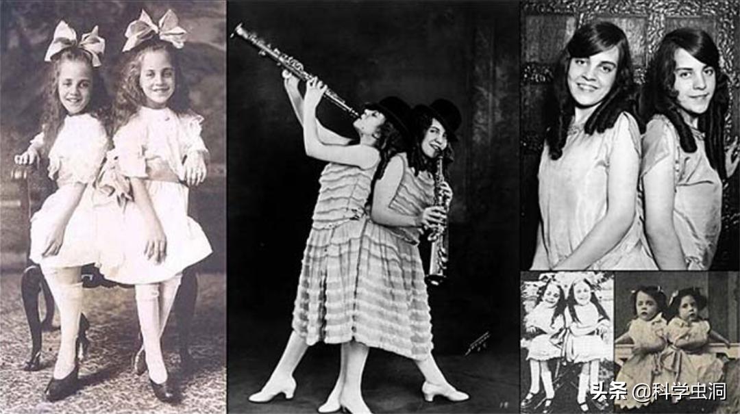 连体姐妹其中一个人死了怎么办,连体姐妹一个死了另一个咋办